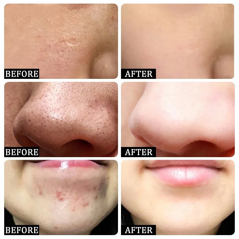 Krem z kwasem salicylowym do o – Korean Skincare Routine recenzja i cena
