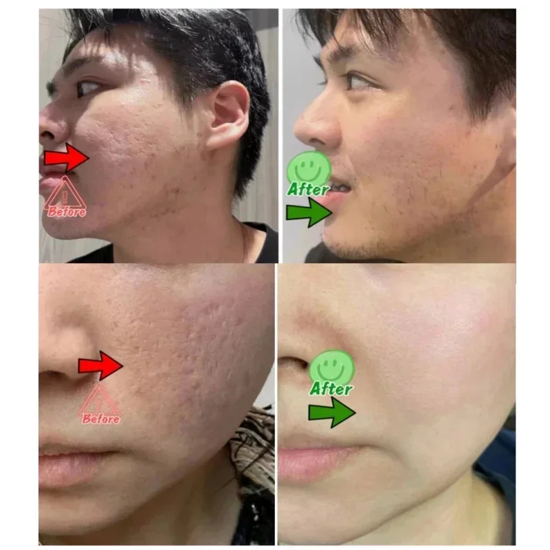 Krem z kwasem salicylowym do o – Korean Skincare Routine recenzja i cena